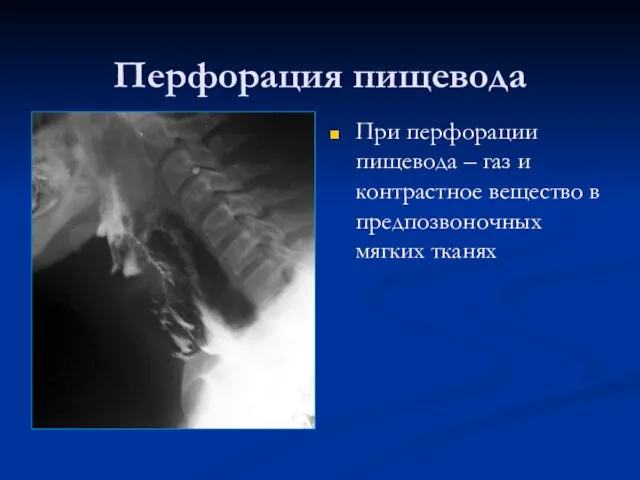 Перфорация пищевода При перфорации пищевода – газ и контрастное вещество в предпозвоночных мягких тканях