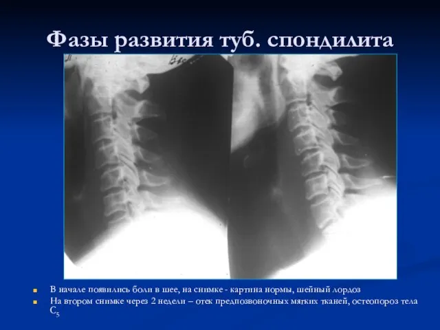 Фазы развития туб. спондилита В начале появились боли в шее, на