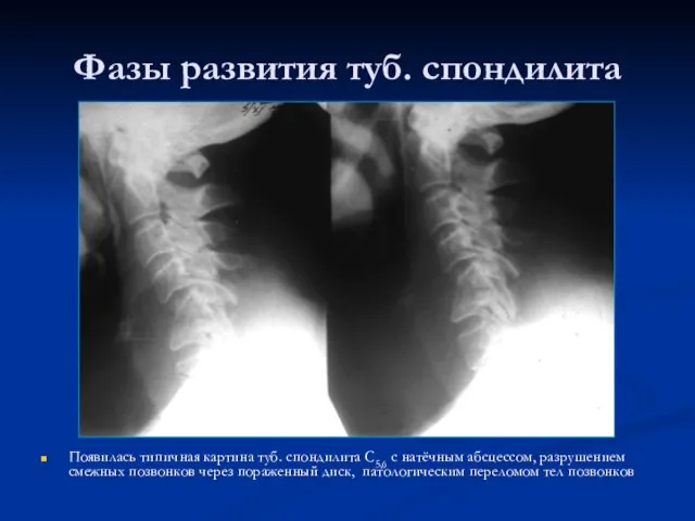 Фазы развития туб. спондилита Появилась типичная картина туб. спондилита С5,6 с