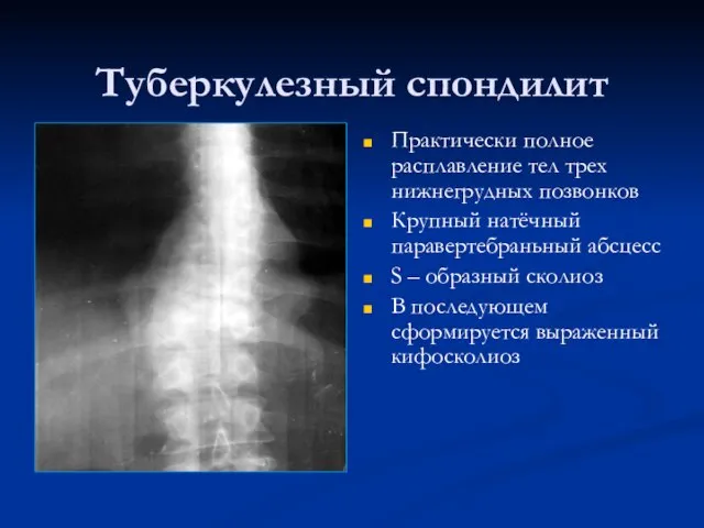 Туберкулезный спондилит Практически полное расплавление тел трех нижнегрудных позвонков Крупный натёчный