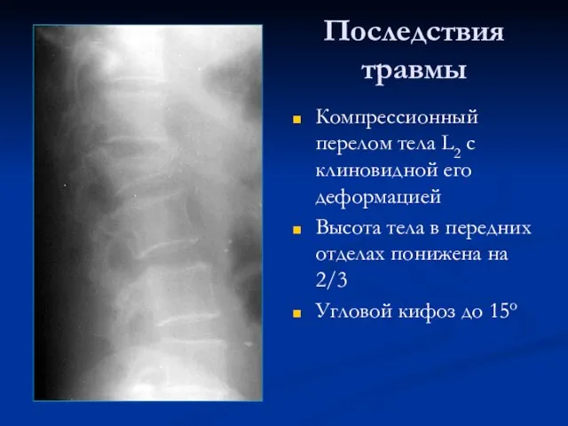 Последствия травмы Компрессионный перелом тела L2 с клиновидной его деформацией Высота