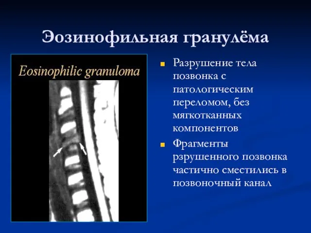 Эозинофильная гранулёма Разрушение тела позвонка с патологическим переломом, без мягкотканных компонентов