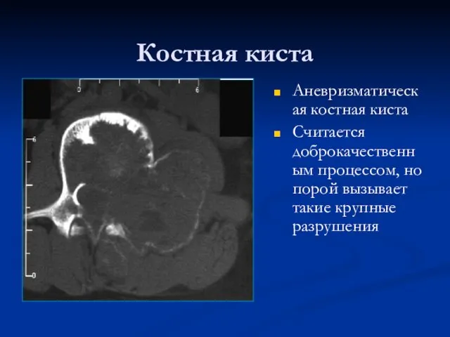 Костная киста Аневризматическая костная киста Считается доброкачественным процессом, но порой вызывает такие крупные разрушения