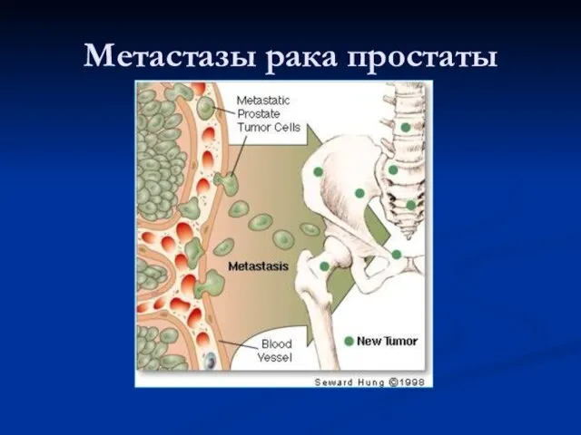 Метастазы рака простаты