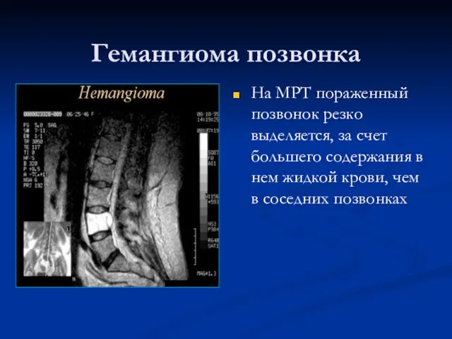 Гемангиома позвонка На МРТ пораженный позвонок резко выделяется, за счет большего