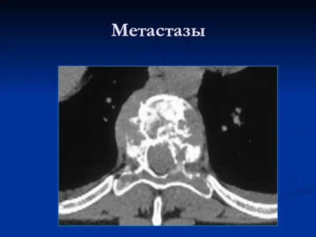 Метастазы