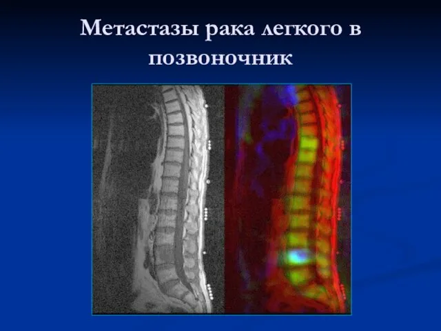 Метастазы рака легкого в позвоночник