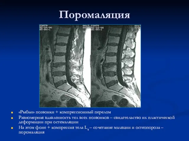 Поромаляция «Рыбьи» позвонки + компрессионный перелом Равномерная вдавленность тел всех позвонков