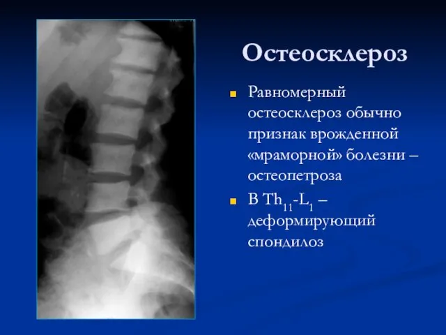 Остеосклероз Равномерный остеосклероз обычно признак врожденной «мраморной» болезни – остеопетроза В Th11-L1 – деформирующий спондилоз