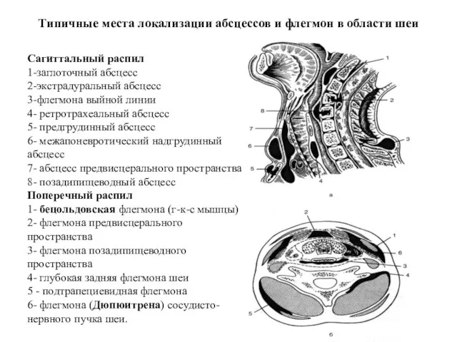 Сагиттальный распил 1-заглоточный абсцесс 2-экстрадуральный абсцесс 3-флегмона выйной линии 4- ретротрахеальный