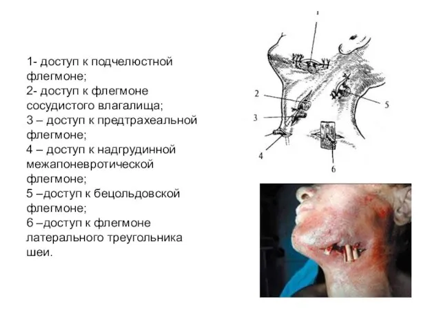 1- доступ к подчелюстной флегмоне; 2- доступ к флегмоне сосудистого влагалища;