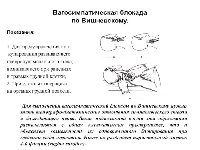 Вагосимпатическая блокада по Вишневскому. Показания: 1. Для предупреждения или купирования развивающего