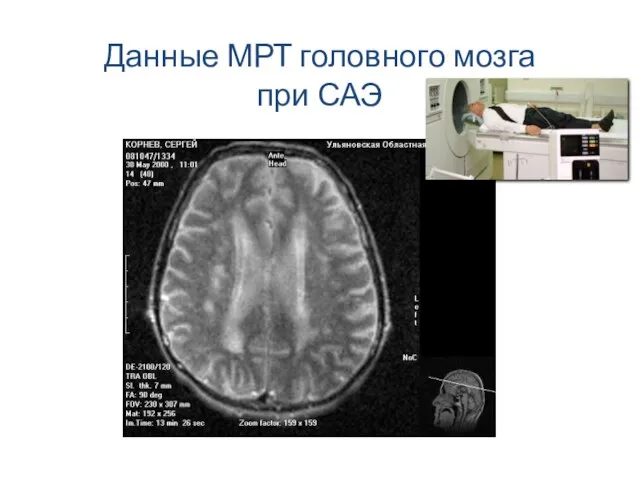 Данные МРТ головного мозга при САЭ