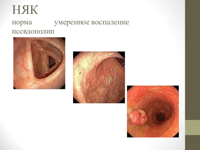 НЯК норма умеренное воспаление псевдополип