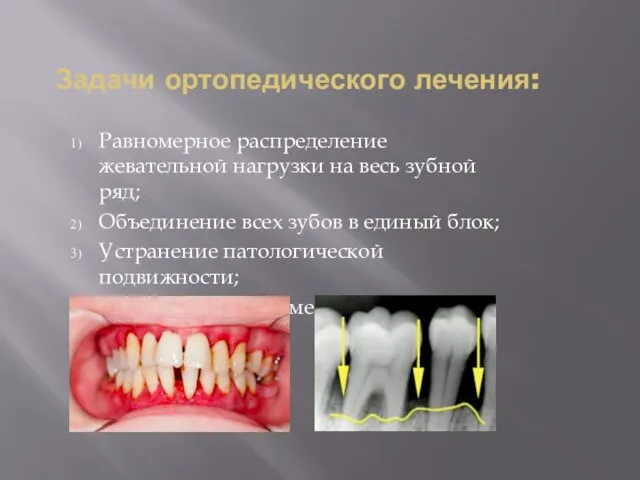 Задачи ортопедического лечения: Равномерное распределение жевательной нагрузки на весь зубной ряд;