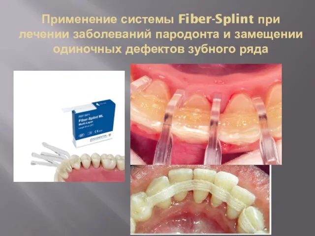 Применение системы Fiber-Splint при лечении заболеваний пародонта и замещении одиночных дефектов зубного ряда