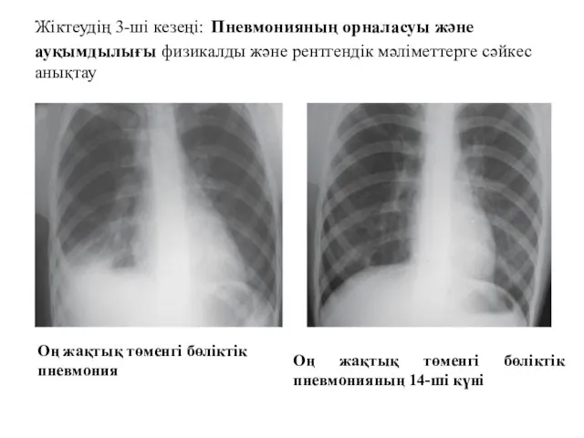 Жіктеудің 3-ші кезеңі: Пневмонияның орналасуы және ауқымдылығы физикалды және рентгендік мәліметтерге