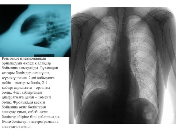 Рентгенде пневмонияның орналасуын өкпелік алаңдар бойынша анықтайды. Бұғанадан жоғары бөлімдер өкпе
