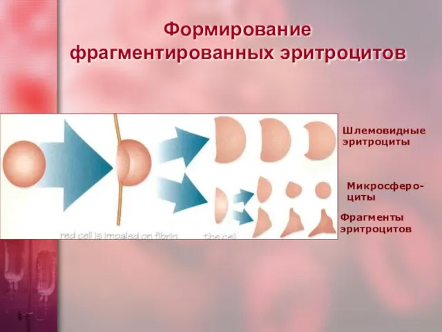 Формирование фрагментированных эритроцитов Шлемовидные эритроциты Микросферо- циты Фрагменты эритроцитов