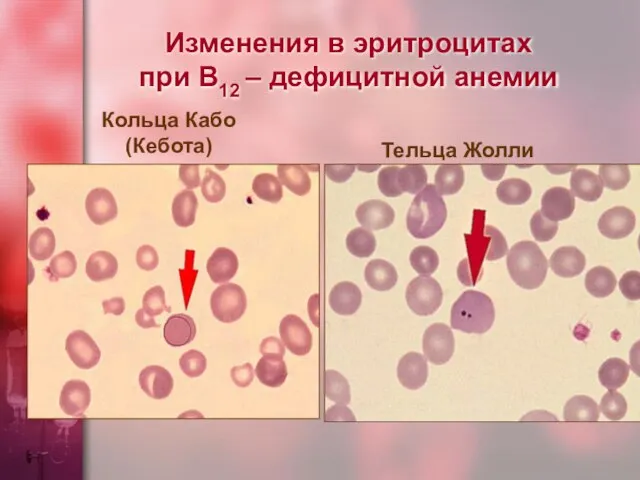 Изменения в эритроцитах при В12 – дефицитной анемии Кольца Кабо (Кебота) Тельца Жолли