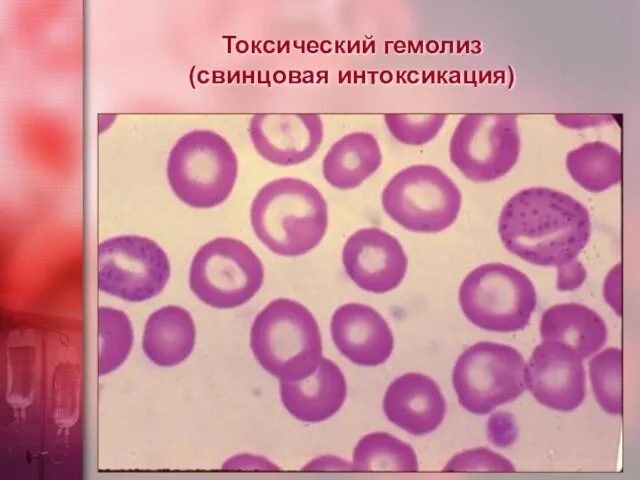 Токсический гемолиз (свинцовая интоксикация)