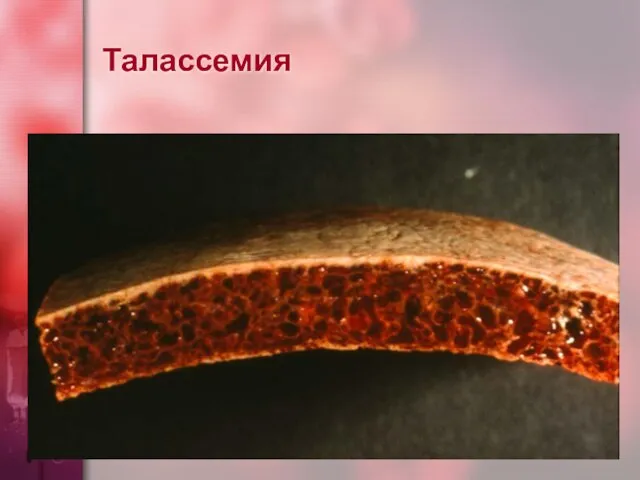 Талассемия