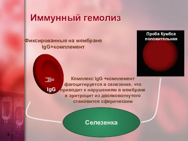 Иммунный гемолиз Селезенка Фиксированные на мембране IgG+комплемент Комплекс IgG +комплемент фагоцитируется