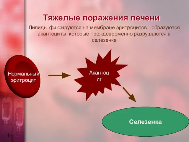 Тяжелые поражения печени Акантоцит Селезенка Липиды фиксируются на мембране эритроцитов, образуются