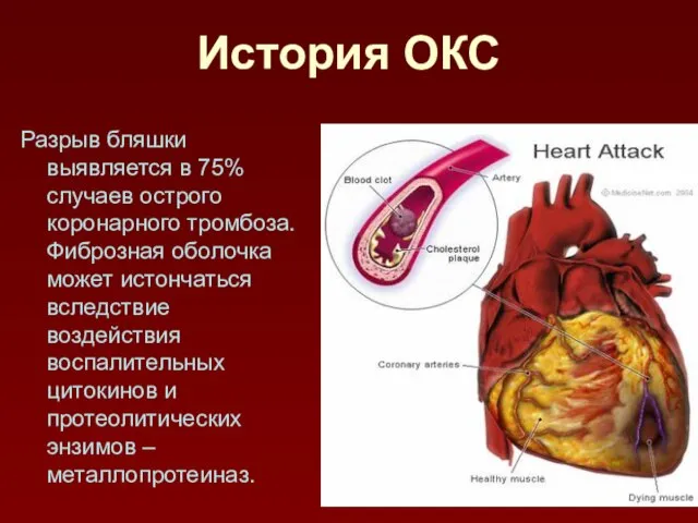 История ОКС Разрыв бляшки выявляется в 75% случаев острого коронарного тромбоза.