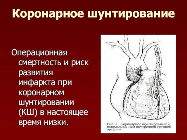 Коронарное шунтирование Операционная смертность и риск развития инфаркта при коронарном шунтировании (КШ) в настоящее время низки.