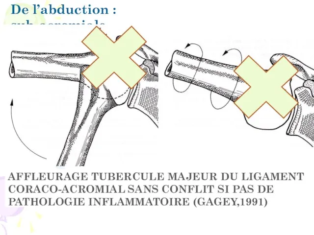 De l’abduction : sub-acromiale Théorique : effet butée trochiter contre acromion