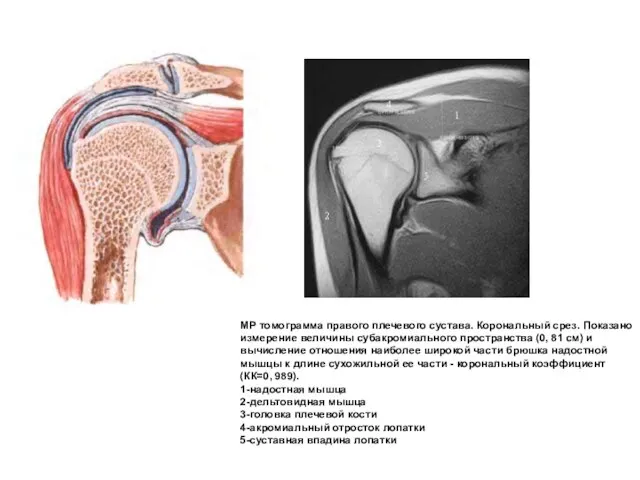 МР томограмма правого плечевого сустава. Корональный срез. Показано измерение величины субакромиального