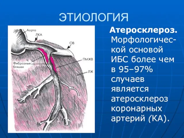 ЭТИОЛОГИЯ Атеросклероз. Морфологичес-кой основой ИБС более чем в 95–97% случаев является атеросклероз коронарных артерий (КА).