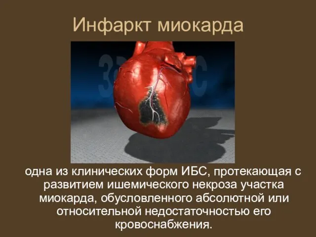Инфаркт миокарда одна из клинических форм ИБС, протекающая с развитием ишемического