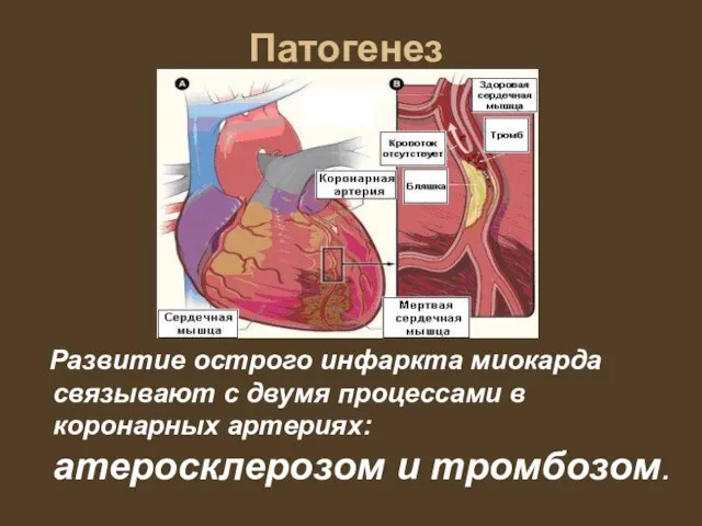 Патогенез Развитие острого инфаркта миокарда связывают с двумя процессами в коронарных артериях: атеросклерозом и тромбозом.