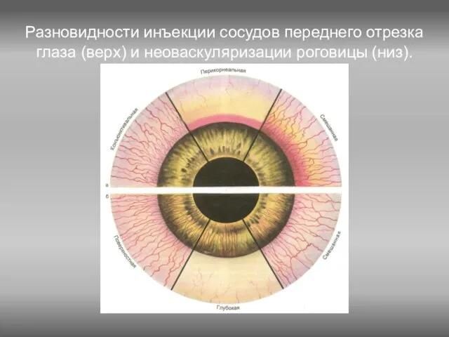 Разновидности инъекции сосудов переднего отрезка глаза (верх) и неоваскуляризации роговицы (низ).