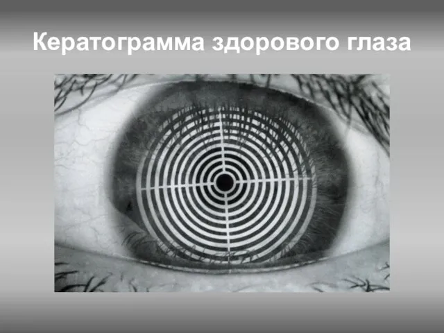 Кератограмма здорового глаза