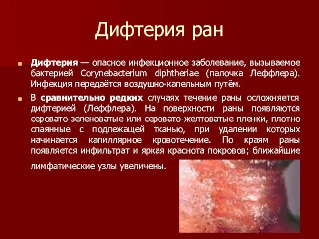 Дифтерия ран Дифтерия — опасное инфекционное заболевание, вызываемое бактерией Corynebacterium diphtheriae