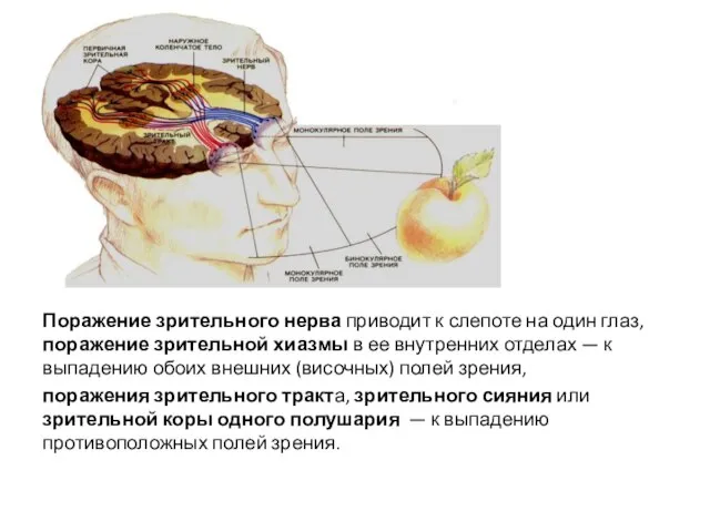 Поражение зрительного нерва приводит к слепоте на один глаз, поражение зрительной