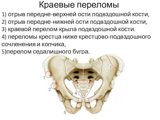 Краевые переломы 1) отрыв передне-верхней ости подвздошной кости, 2) отрыв передне-нижней