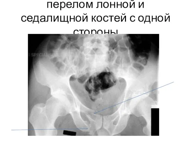 перелом лонной и седалищной костей с одной стороны