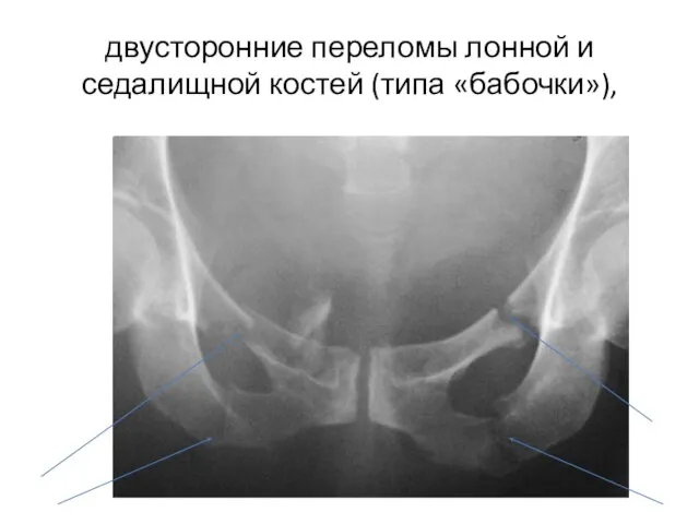 двусторонние переломы лонной и седалищной костей (типа «бабочки»),