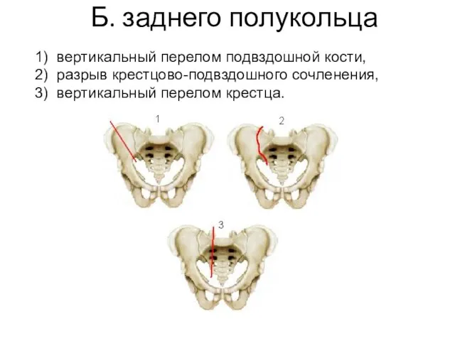 Б. заднего полукольца 1) вертикальный перелом подвздошной кости, 2) разрыв крестцово-подвздошного сочленения, 3) вертикальный перелом крестца.