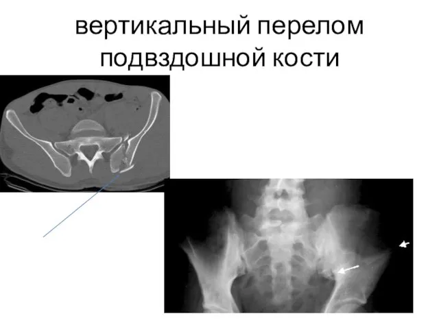 вертикальный перелом подвздошной кости