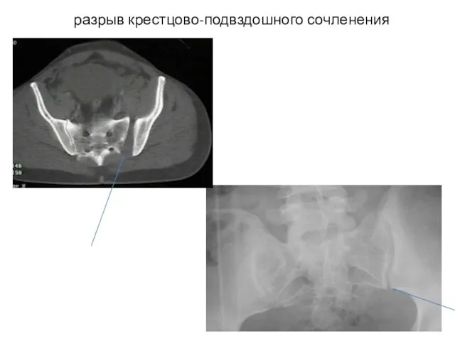 разрыв крестцово-подвздошного сочленения