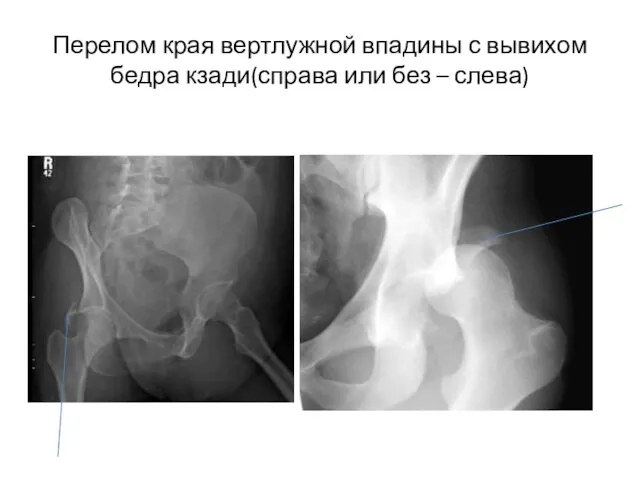 Перелом края вертлужной впадины с вывихом бедра кзади(справа или без – слева)