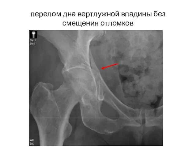 перелом дна вертлужной впадины без смещения отломков