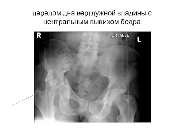 перелом дна вертлужной впадины с центральным вывихом бедра