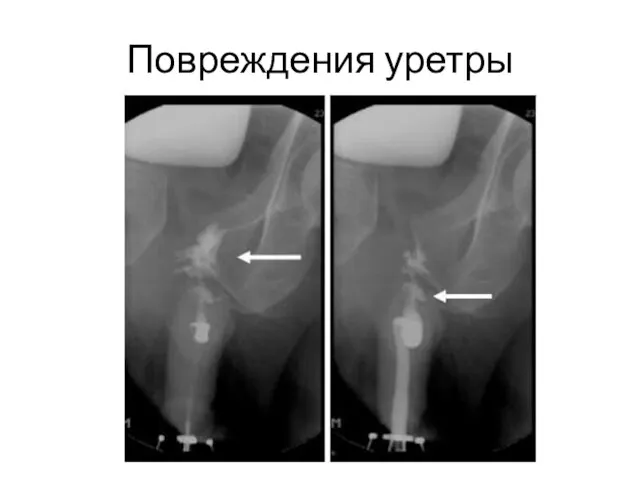 Повреждения уретры