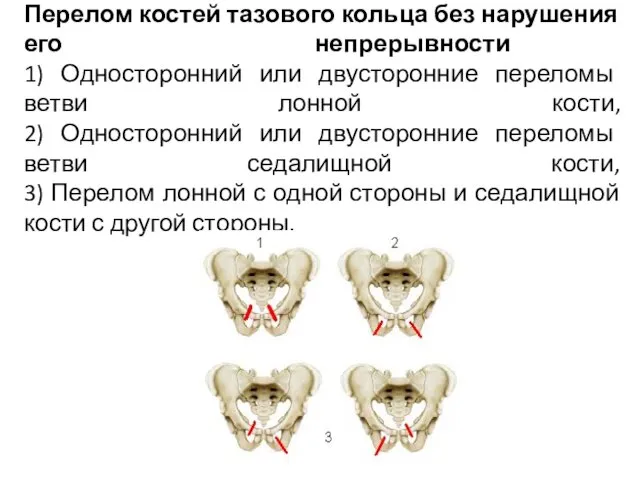 Перелом костей тазового кольца без нарушения его непрерывности 1) Односторонний или